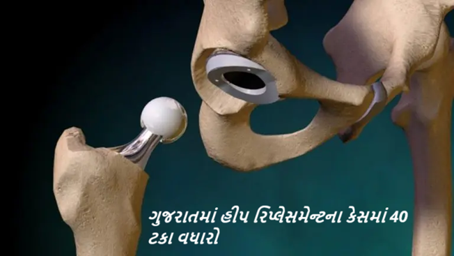 કોરોના વાઇસ હવે ભૂતકાળ બની ગયો છે પણ તેની અસર હજુ કોઇને કોઇ રીતે સ્વાસ્થ્ય પર જોવા મળે છે , હીપ રિપ્લેસમેન્ટના કેસમાં 40 ટકા વધારો, 80 ટકા લોકો તો 50થી ઓછી વયના ,